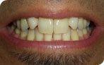 Before dental procedure